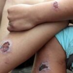 Falleció una adolescente de 15 años por leishmaniasis en Salta